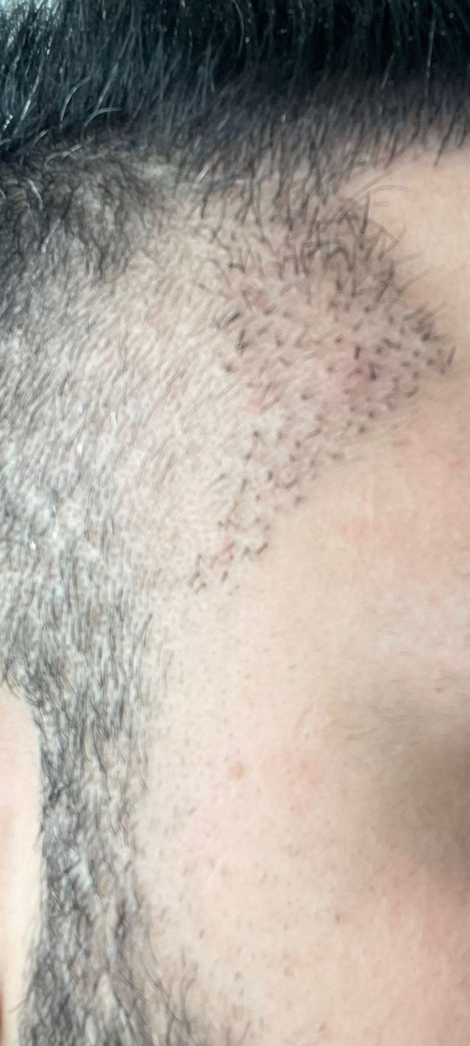 Engin Sönmez Hair Transplant  Reviews